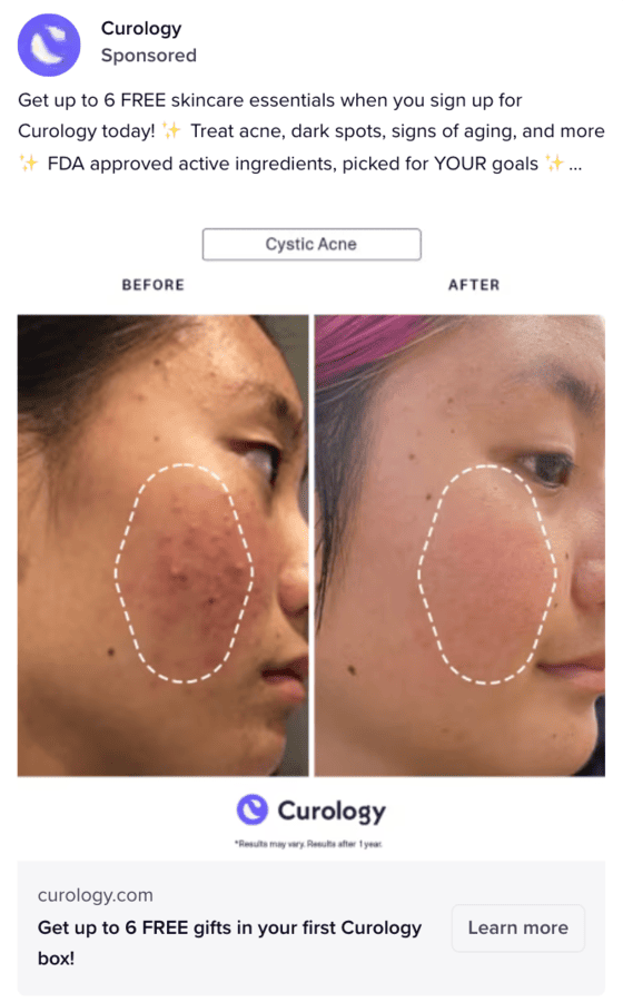 Curology before and after ad